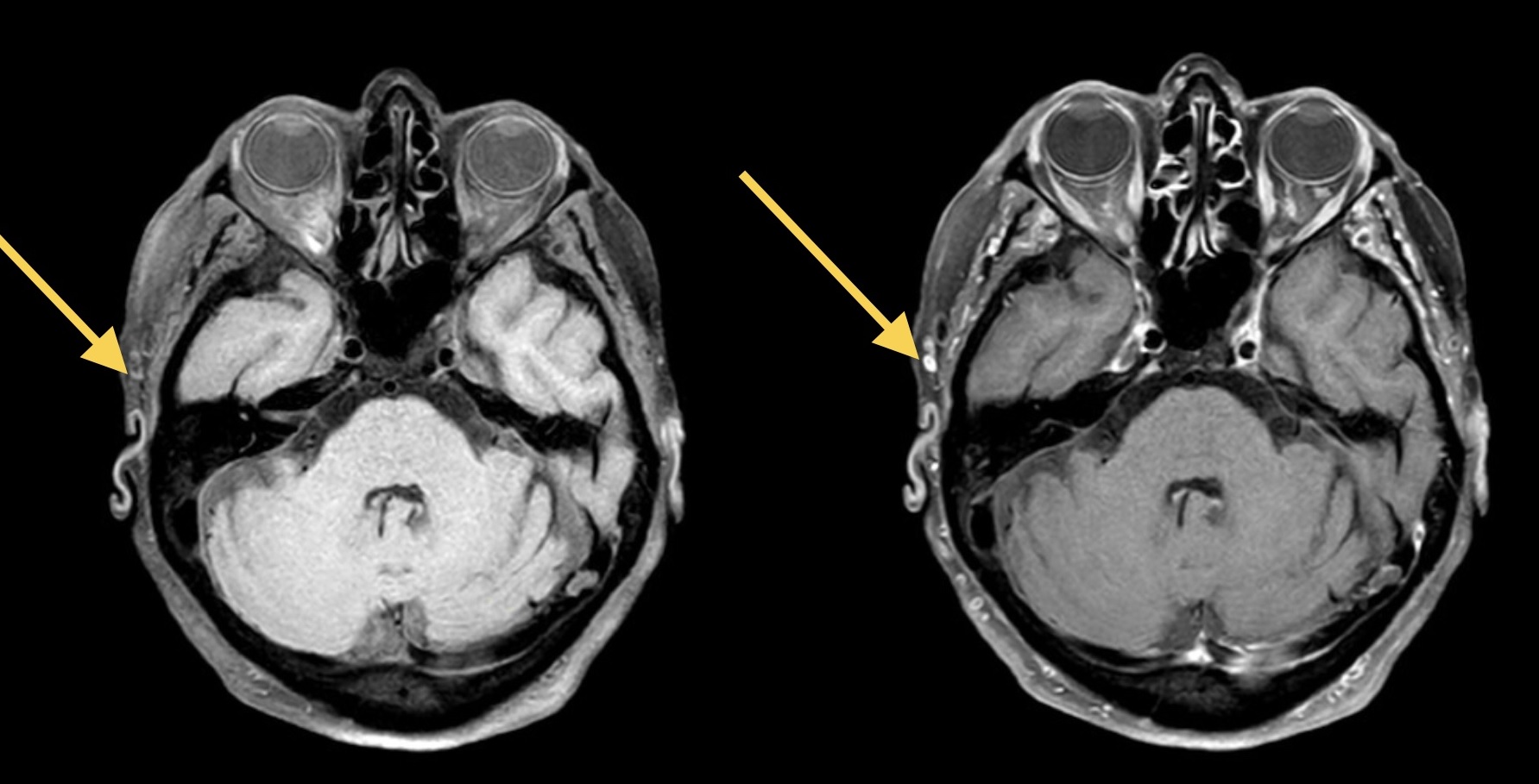 Edema Facial