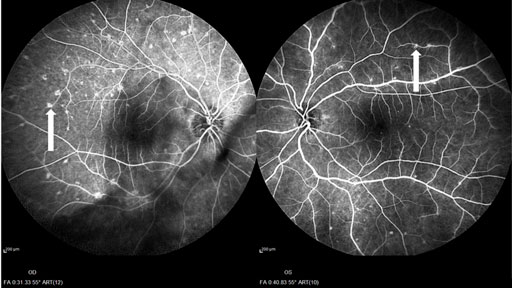 retinoplastia