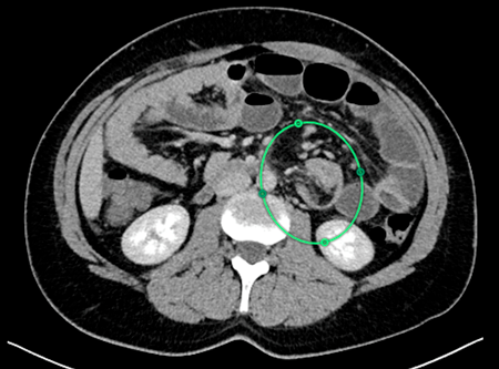 Tumor Miofibroblástico