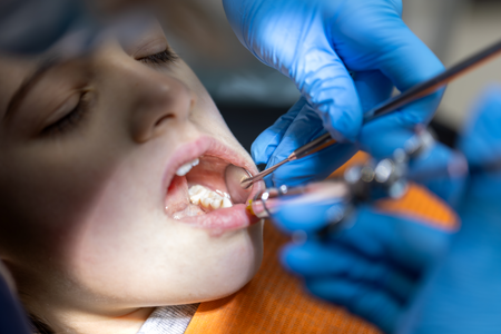 Autotrasplante dental 
